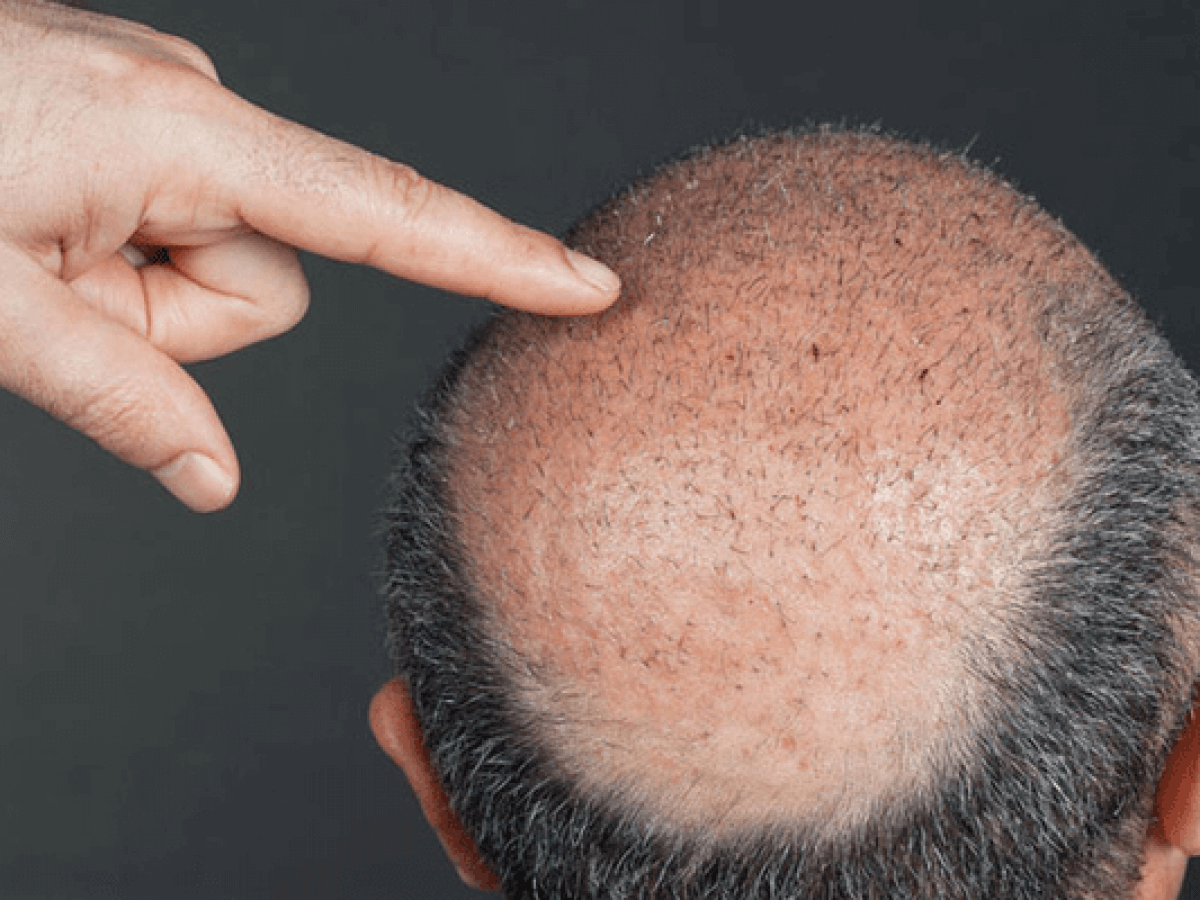 Saç Ekimi 1 fue yontemi ile sac ekimi min 1200x900 2