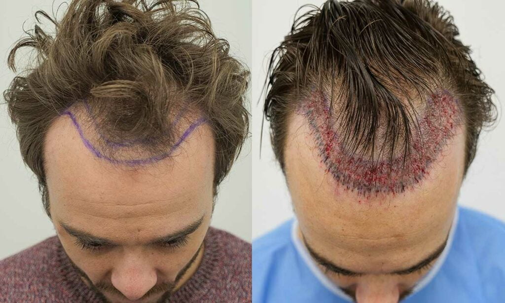 hair transplant before and after