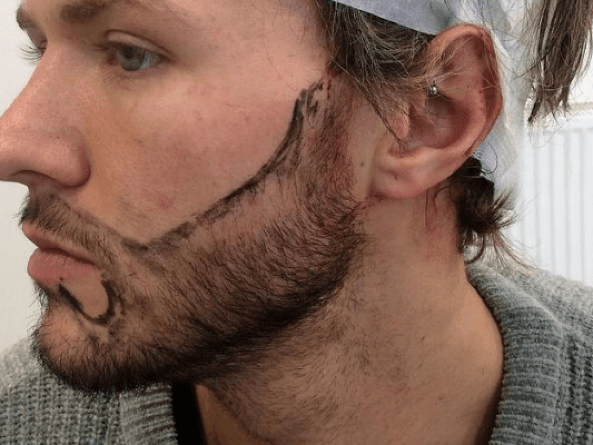 Saç Ekimi 2 sakal-ekimi-nedir- mediavrupa estetik