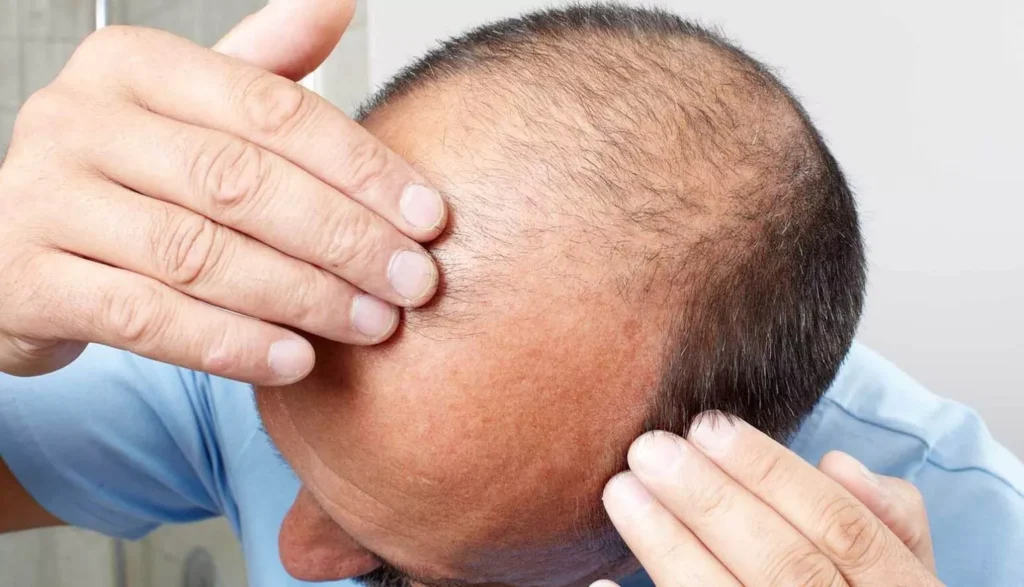 saç ekimi mediavrupa