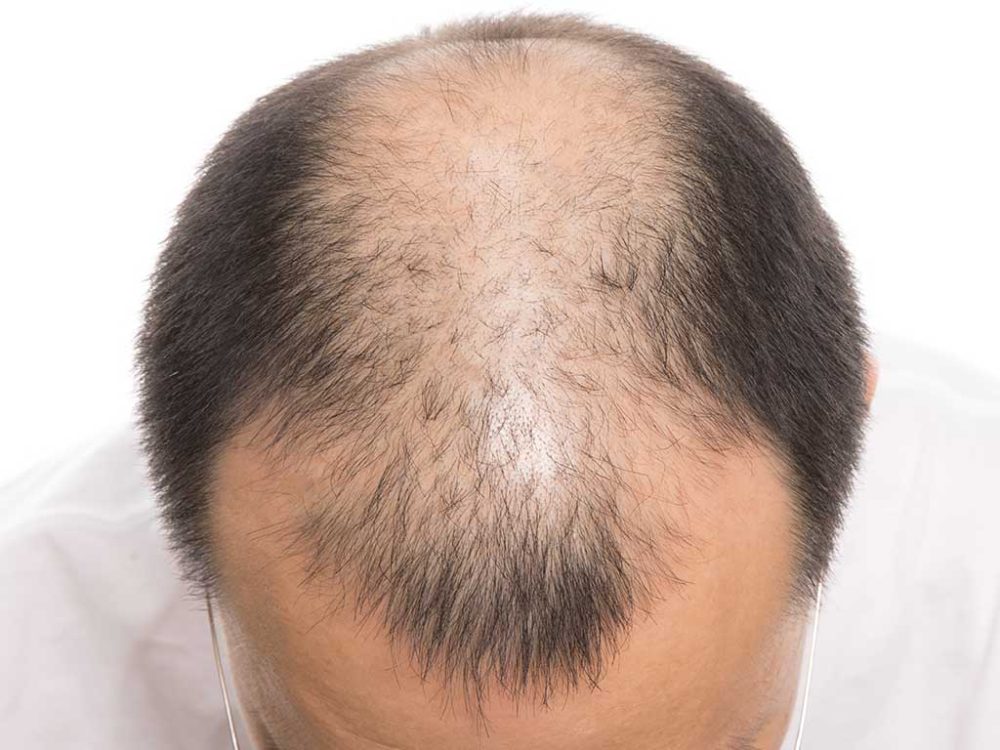 sac-ekimi-hakkinda-merak-edilenler