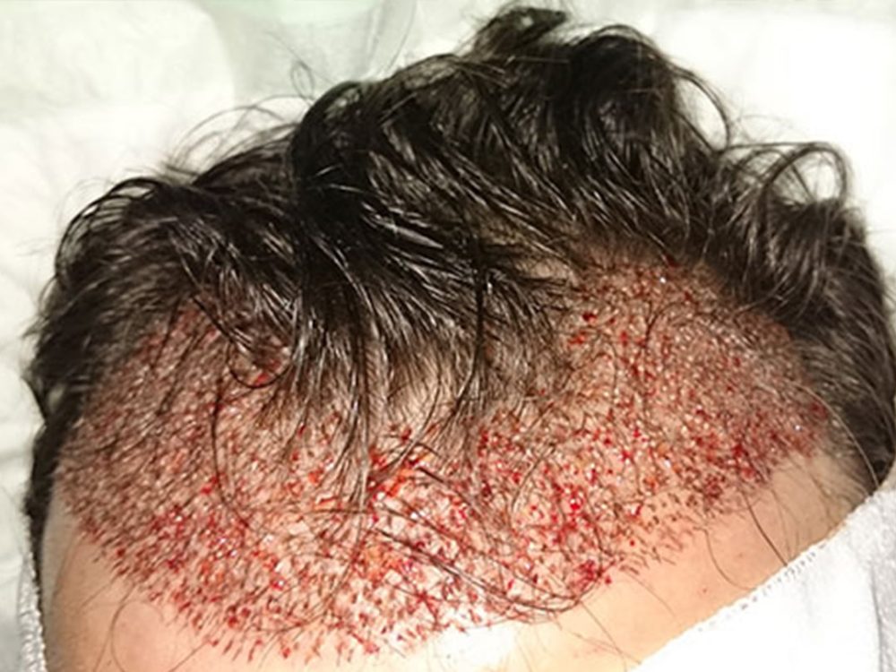 saç ekimi mediavrupa